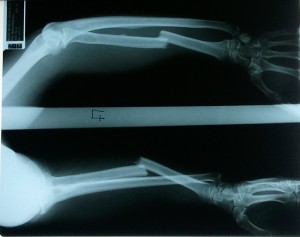 x-ray